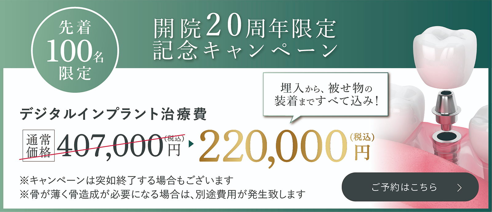 先着100名限定 / 開院20周年限定記念キャンペーン / デジタルインプラント治療費　通常価格407,000円（税込）→220,000円（税込）埋入から、被せ物の装着まですべて込み！ / ※キャンペーンは突如終了する場合もございます / ※骨が薄く骨造成が必要になる場合は、別途費用が発生致します / 詳しくはこちら
